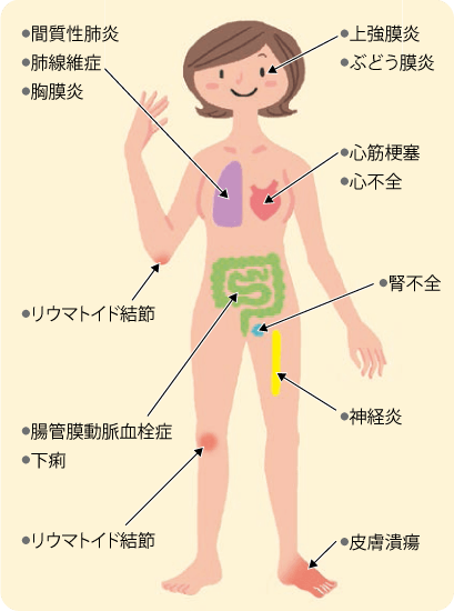 関節リウマチはどんな症状がみられますか リウマチ情報ポータル あゆみ製薬