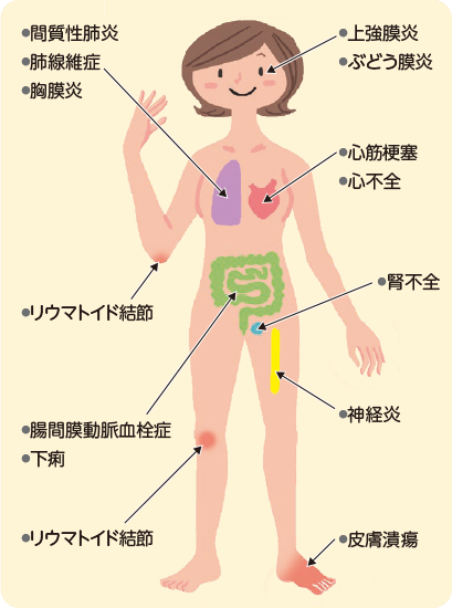  ( 図4 ) 関節以外に起こる可能性がある症状