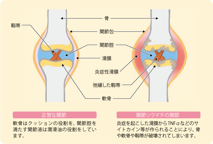 正常な関節では、軟骨はクッションの役割を、関節腔を満たす関節液は潤滑油の役割をしています。