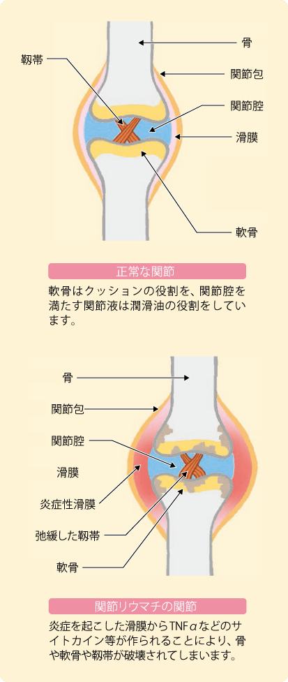 サイトカイン 炎症 性