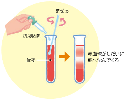 関節リウマチの目の合併症